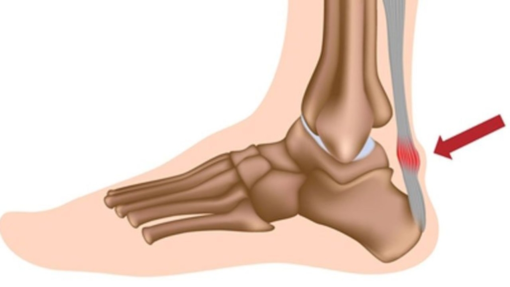 Viêm gân gót là tình trạng viêm gân liên kết nối cơ bắp chân và gót chân cảu bạn. Nó thường xảy ra khi tăng số Km hoặc cường độ chạy của bạn lên trên mức bình thường.